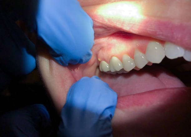 Best Broken or Chipped Tooth Repair in Trenton, OH